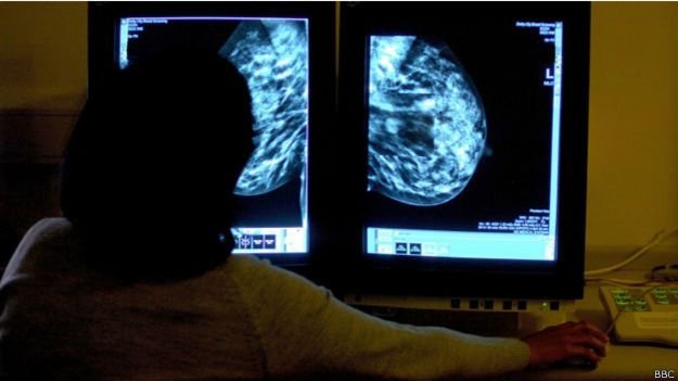 http://ichef.bbci.co.uk/news/ws/625/amz/worldservice/live/assets/images/2015/02/23/150223164135_cancer_mammogramme_624x351_bbc.jpg