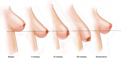 Разные виды формы груди по системе Лоренцони | «Левел Клиник»