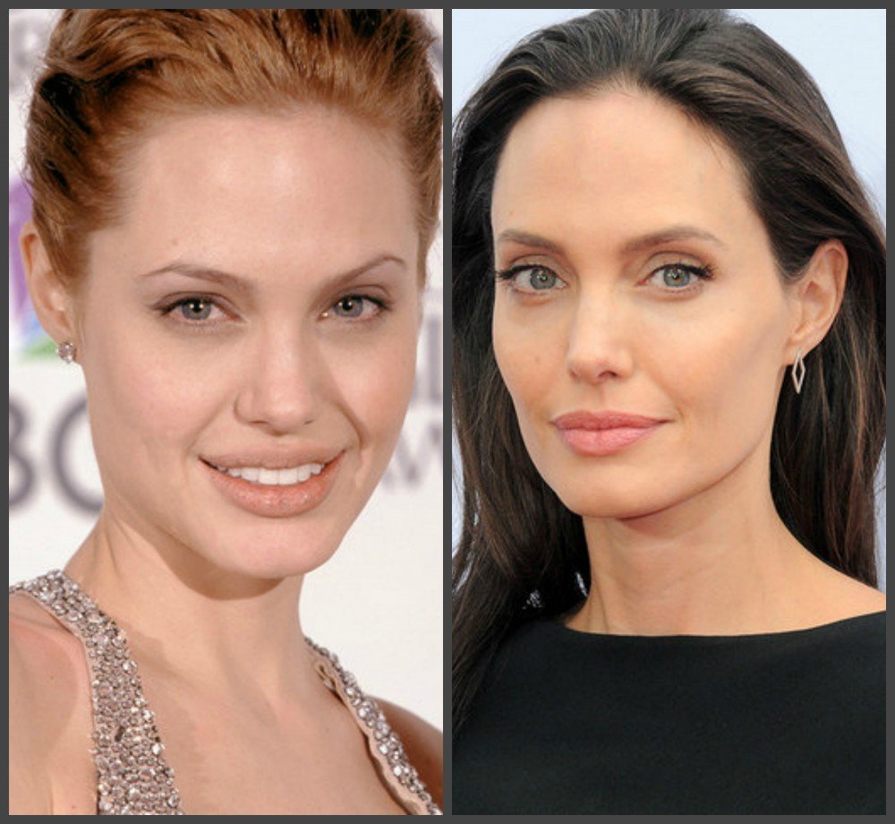 Что такое комки биша. Анджелина Джоли мешки Биша. Щеки до и после. Впалые щеки пластика.