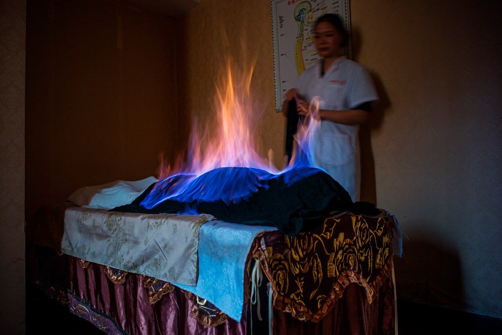 Местная терапия с огнем в Чэнду, Китай